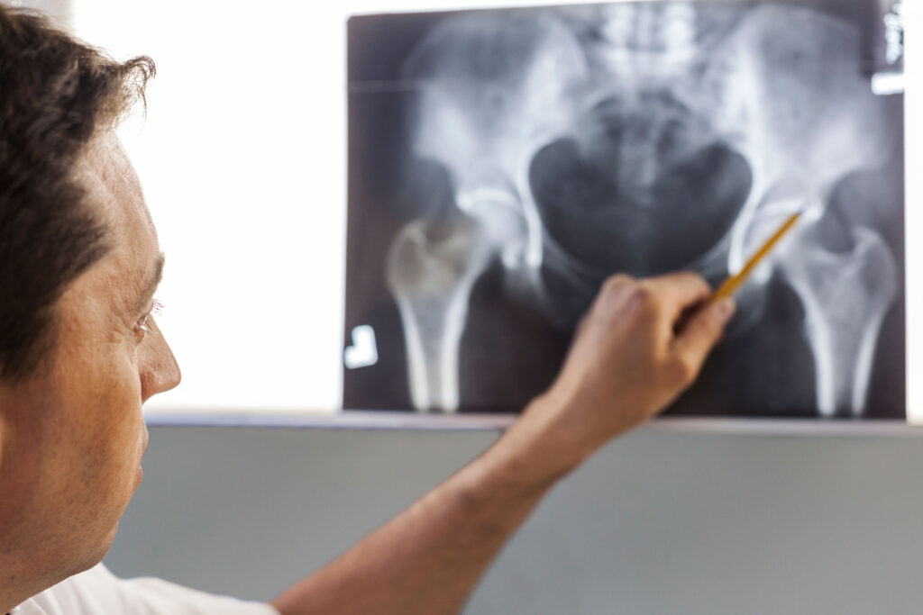 Hip: Finding The Right Hip Doctor 3 Hip img 04 20250521