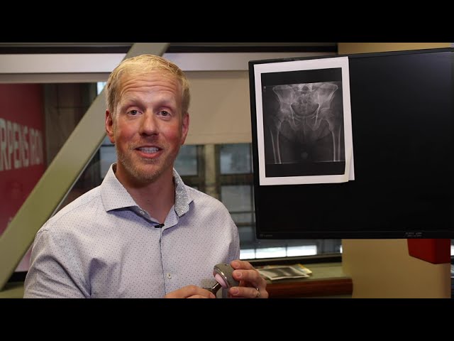 What you need to know about hip replacement