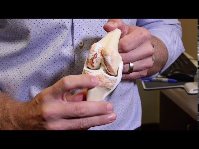 What you need to know about a knee replacement